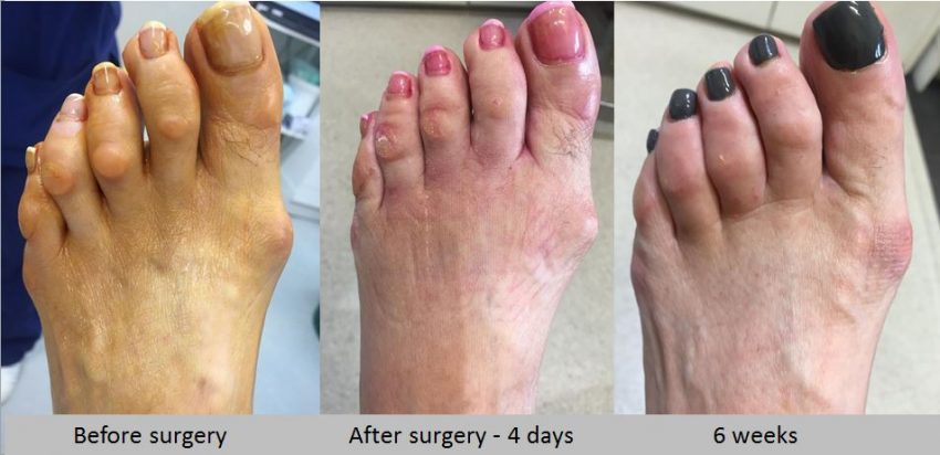 Recovery time for 2025 hammer toe surgery